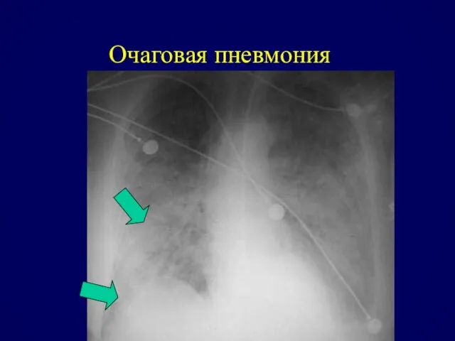 Очаговая пневмония