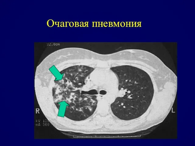 Очаговая пневмония