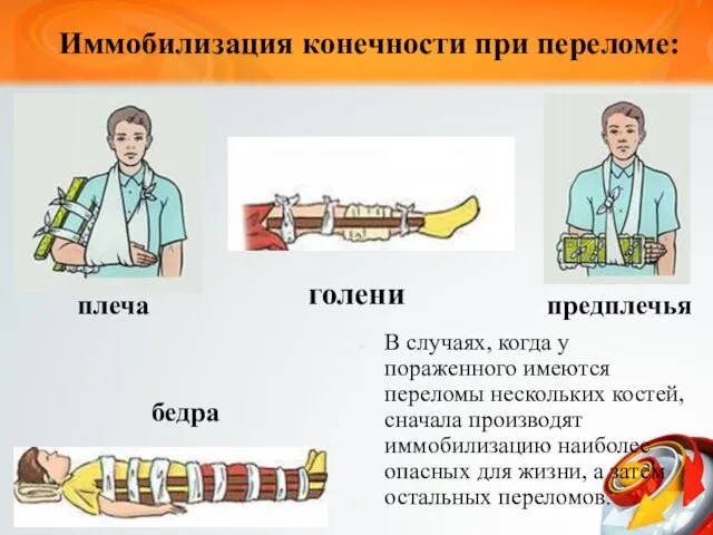 Иммобилизация конечности при переломе: плеча предплечья бедра голени В случаях, когда