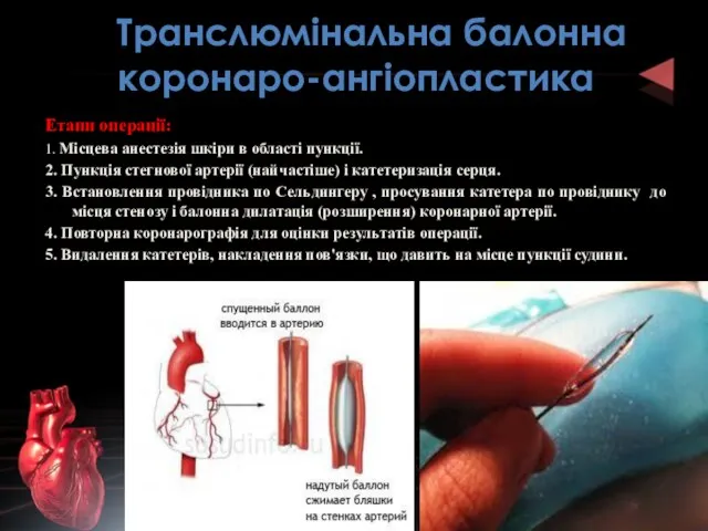 Транслюмінальна балонна коронаро-ангіопластика Етапи операції: 1. Місцева анестезія шкіри в області
