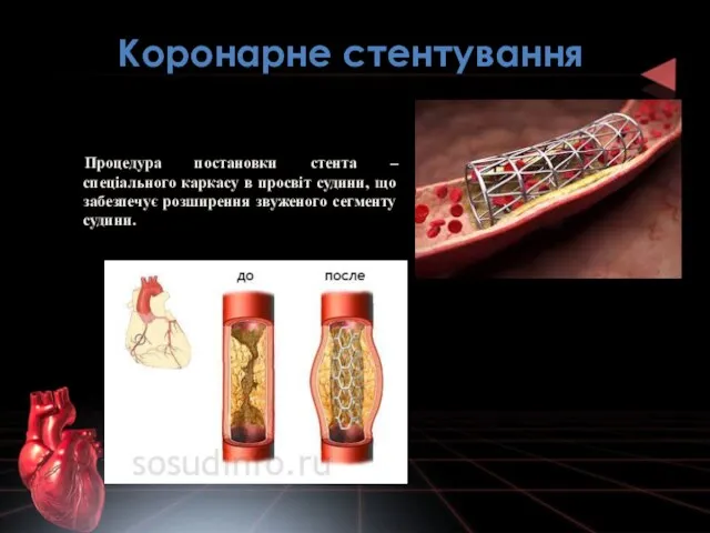 Коронарне стентування Процедура постановки стента – спеціального каркасу в просвіт судини,