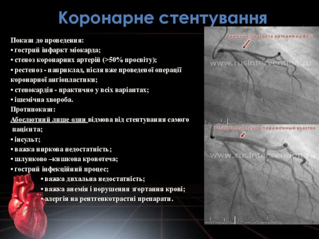 Коронарне стентування Покази до проведення: • гострий інфаркт міокарда; • стеноз