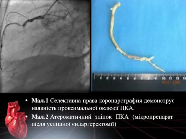 Мал.1 Селективна права коронарография демонструє наявність проксимальної оклюзії ПКА. Мал.2 Атероматичний