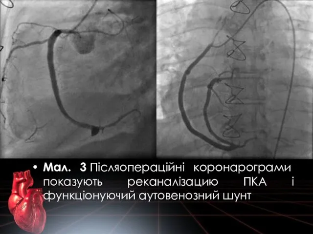 Мал. 3 Післяопераційні коронарограми показують реканалізацию ПКА і функціонуючий аутовенозний шунт