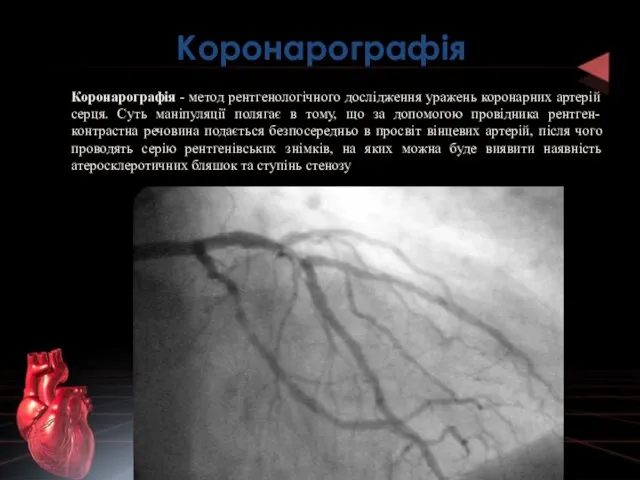 Коронарографія Коронарографія - метод рентгенологічного дослідження уражень коронарних артерій серця. Суть