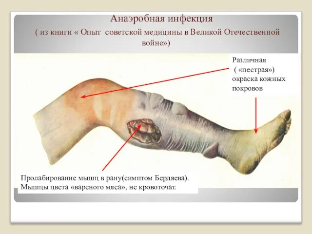 Анаэробная инфекция ( из книги « Опыт советской медицины в Великой
