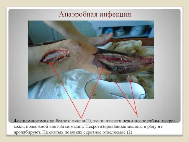 Анаэробная инфекция Фасциомиотомия на бедре и голени(1), ткани отчасти нежизнеспособны- некроз