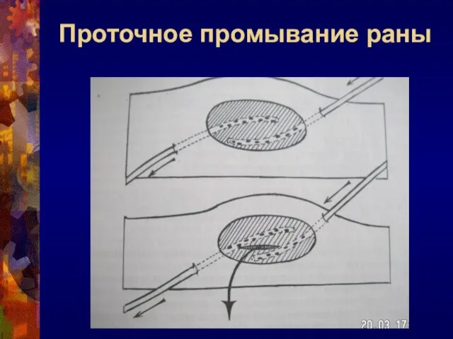 Проточное промывание раны