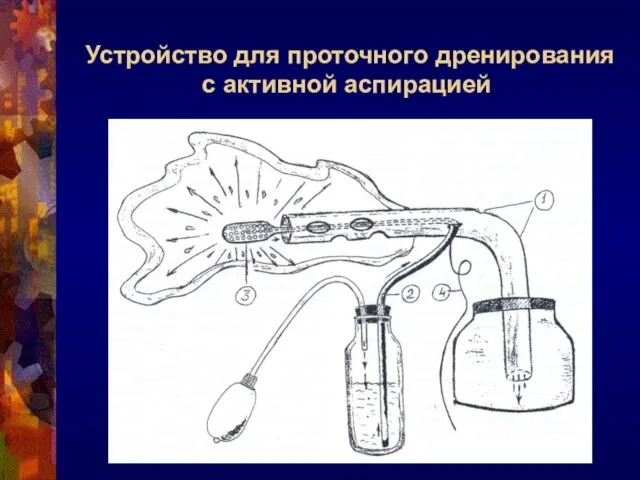 Устройство для проточного дренирования с активной аспирацией