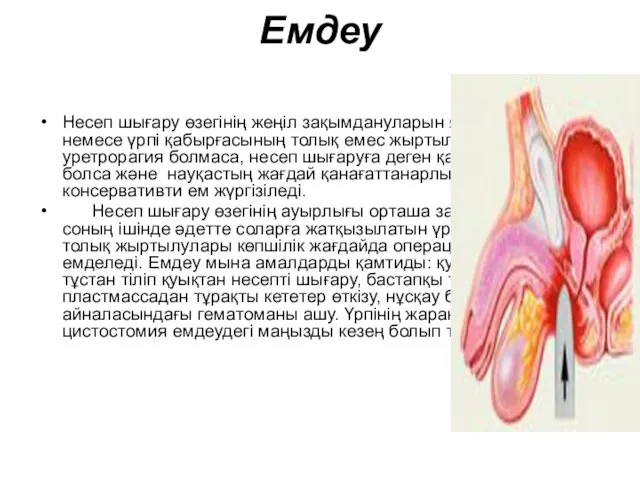 Емдеу Несеп шығару өзегінің жеңіл зақымдануларын яғни соғылуын немесе үрпі қабырғасының
