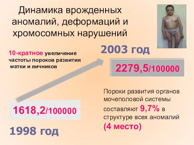 Динамика врожденных аномалий, деформаций и хромосомных нарушений 1998 год 1618,2/100000 2003