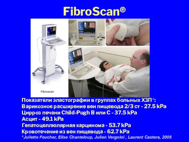FibroScan® Показатели эластографии в группах больных ХЗП*: Варикозное расширение вен пищевода