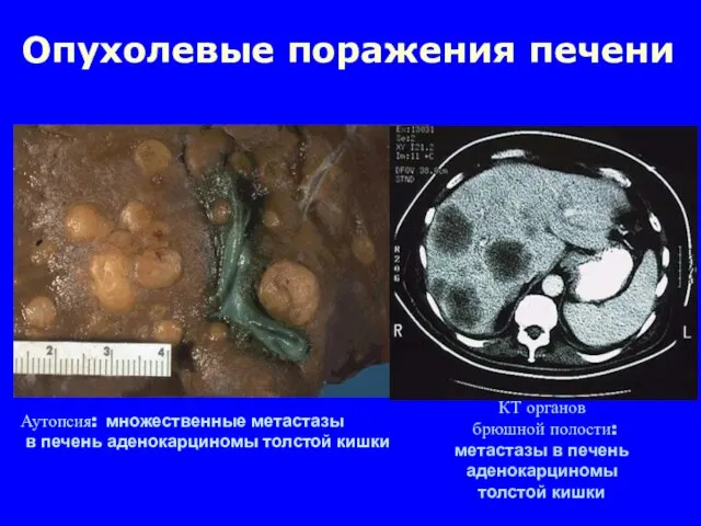 Аутопсия: множественные метастазы в печень аденокарциномы толстой кишки КТ органов брюшной