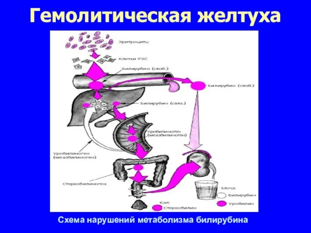 Гемолитическая желтуха Схема нарушений метаболизма билирубина