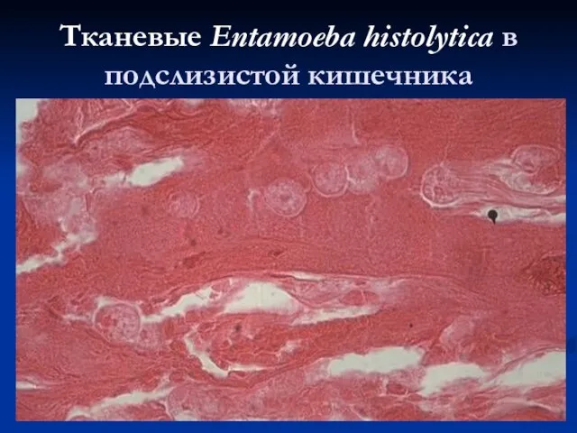 Тканевые Entamoeba histolytica в подслизистой кишечника