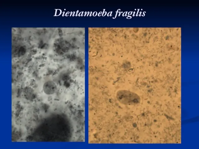 Dientamoeba fragilis