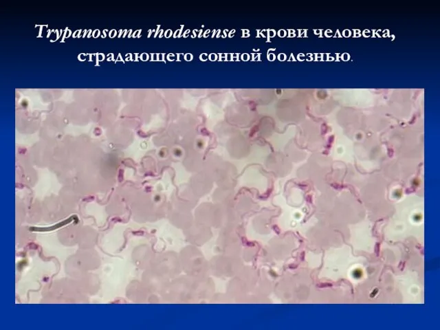 Trypanosoma rhodesiense в крови человека, страдающего сонной болезнью.