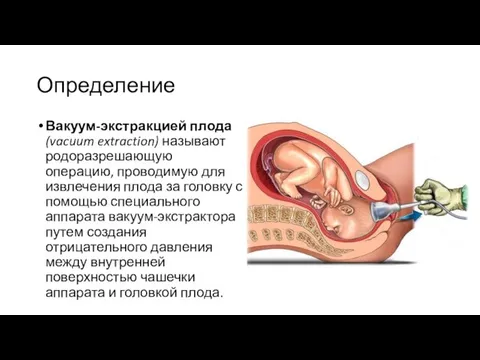 Определение Вакуум-экстракцией плода (vacuum extraction) называют родоразрешающую операцию, проводимую для извлечения