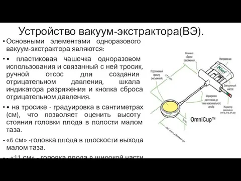 Устройство вакуум-экстрактора(ВЭ). Основными элементами одноразового вакуум-экстрактора являются: • пластиковая чашечка одноразовом