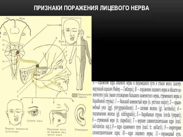 ПРИЗНАКИ ПОРАЖЕНИЯ ЛИЦЕВОГО НЕРВА