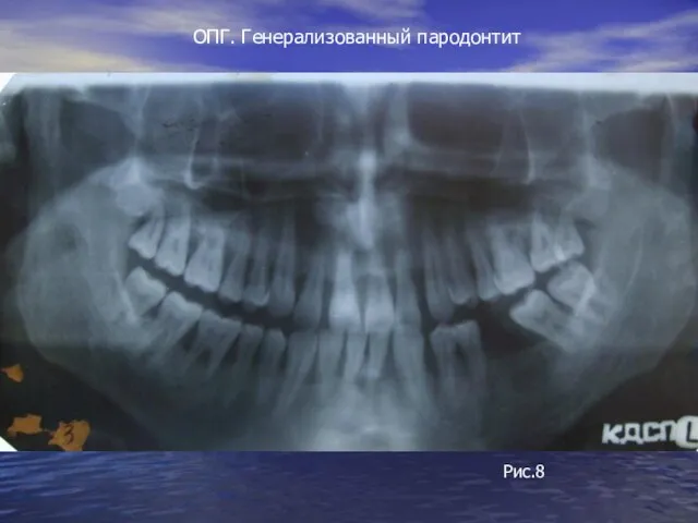 ОПГ. Генерализованный пародонтит Рис.8