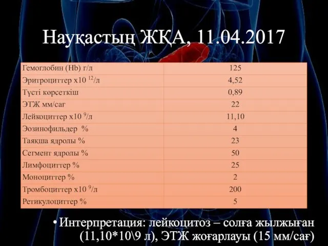 Науқастың ЖҚА, 11.04.2017 Интерпретация: лейкоцитоз – солға жылжыған (11,10*10\9 л), ЭТЖ жоғарлауы (15 мм/сағ)