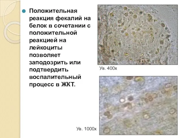 Положительная реакция фекалий на белок в сочетании с положительной реакцией на