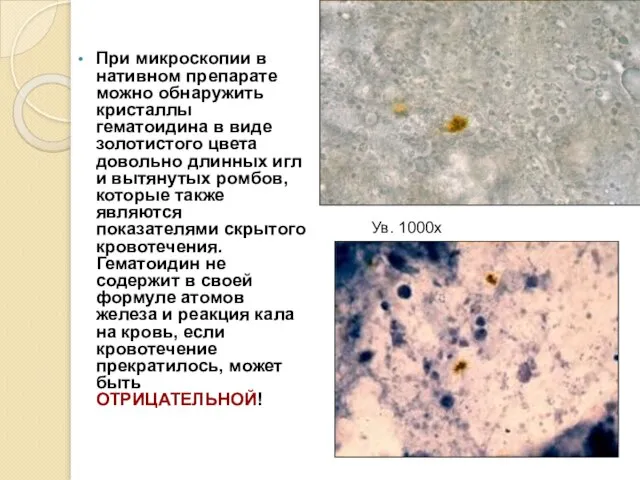 При микроскопии в нативном препарате можно обнаружить кристаллы гематоидина в виде