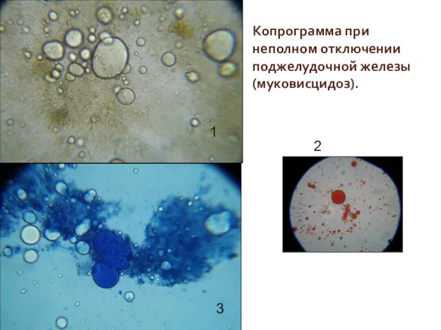 Копрограмма при неполном отключении поджелудочной железы (муковисцидоз). 1 3 2