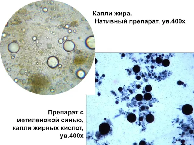 Капли жира. Нативный препарат, ув.400х Препарат с метиленовой синью, капли жирных кислот, ув.400х