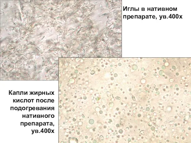 Иглы в нативном препарате, ув.400х Капли жирных кислот после подогревания нативного препарата, ув.400х