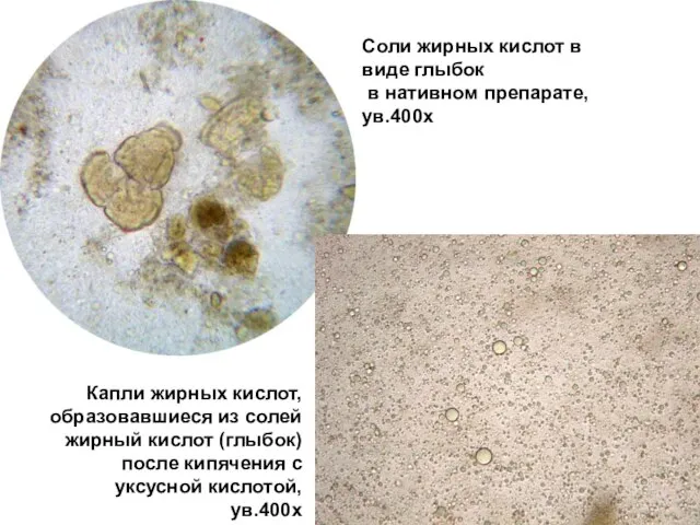 Соли жирных кислот в виде глыбок в нативном препарате, ув.400х Капли