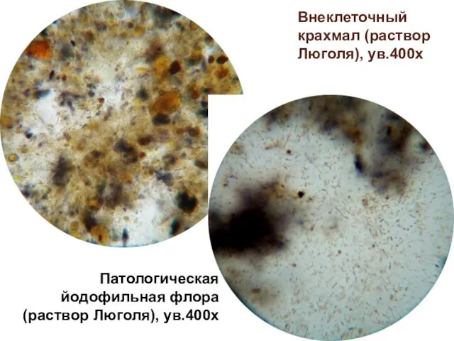 Внеклеточный крахмал (раствор Люголя), ув.400х Патологическая йодофильная флора (раствор Люголя), ув.400х