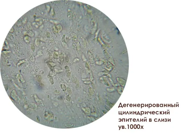 Дегенерированный цилиндрический эпителий в слизи ув.1000х