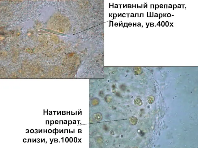 Нативный препарат, кристалл Шарко-Лейдена, ув.400х Нативный препарат, эозинофилы в слизи, ув.1000х