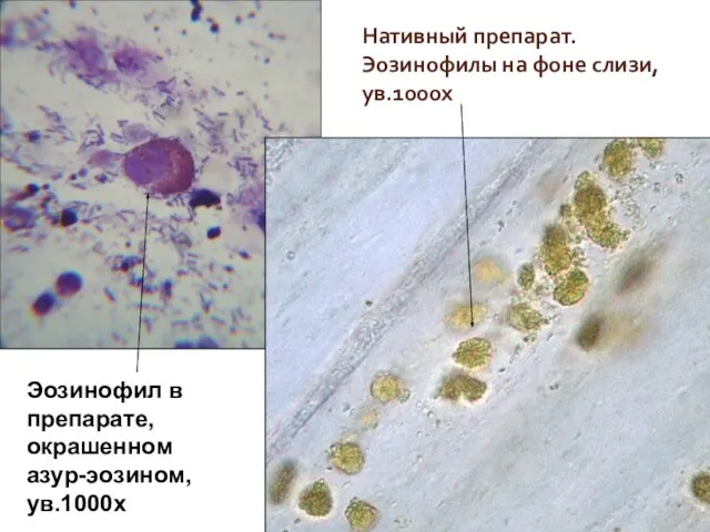 Нативный препарат. Эозинофилы на фоне слизи, ув.1000х Эозинофил в препарате, окрашенном азур-эозином, ув.1000х