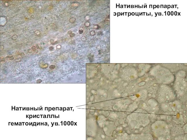 Нативный препарат, эритроциты, ув.1000х Нативный препарат, кристаллы гематоидина, ув.1000х