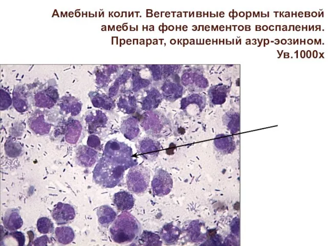 Амебный колит. Вегетативные формы тканевой амебы на фоне элементов воспаления. Препарат, окрашенный азур-эозином. Ув.1000х