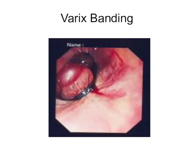 Varix Banding