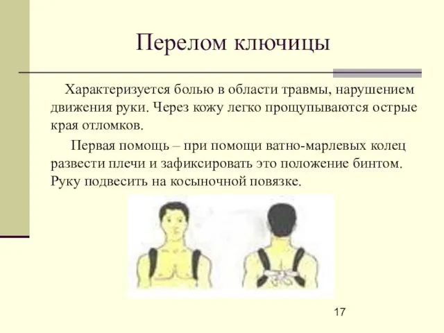 Перелом ключицы Характеризуется болью в области травмы, нарушением движения руки. Через