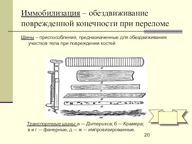 Иммобилизация – обездвиживание поврежденной конечности при переломе Шины – приспособления, предназначенные