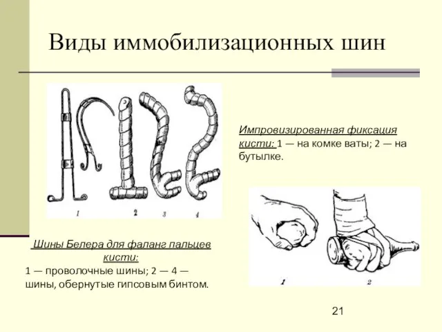 Виды иммобилизационных шин Шины Белера для фаланг пальцев кисти: 1 —