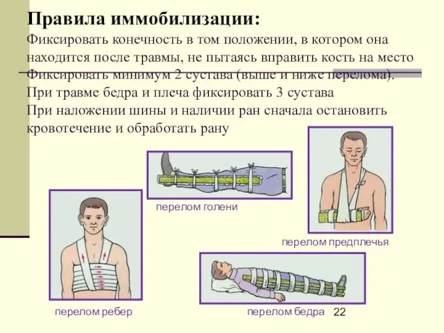 Правила иммобилизации: Фиксировать конечность в том положении, в котором она находится