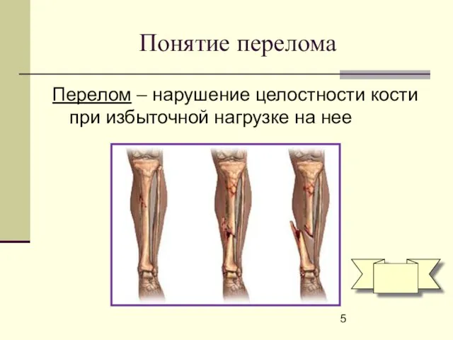 Понятие перелома Перелом – нарушение целостности кости при избыточной нагрузке на нее