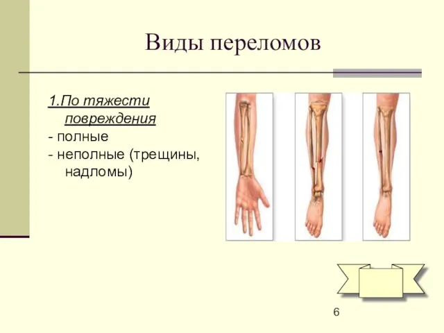 Виды переломов 1.По тяжести повреждения - полные - неполные (трещины, надломы)