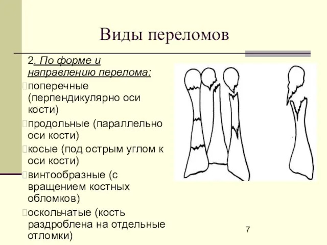 Виды переломов 2. По форме и направлению перелома: поперечные (перпендикулярно оси