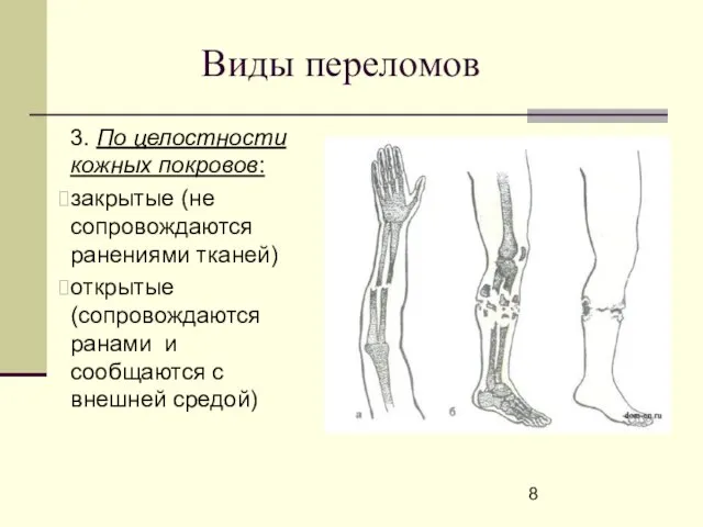 Виды переломов 3. По целостности кожных покровов: закрытые (не сопровождаются ранениями