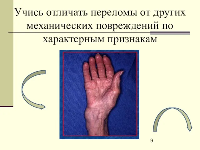 Учись отличать переломы от других механических повреждений по характерным признакам