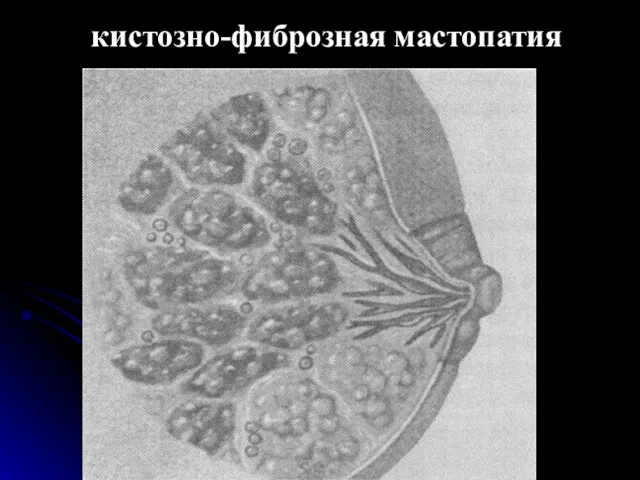 кистозно-фиброзная мастопатия