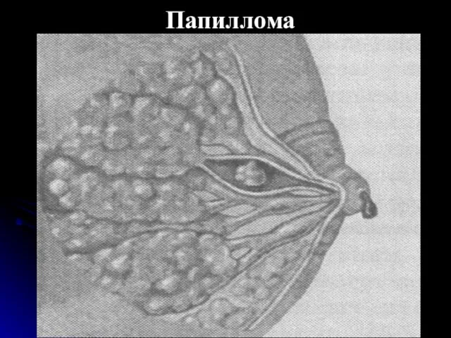 Папиллома